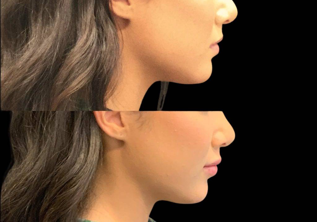 22-year-old-female-lip-augmentation-before-and-after-2.jpg