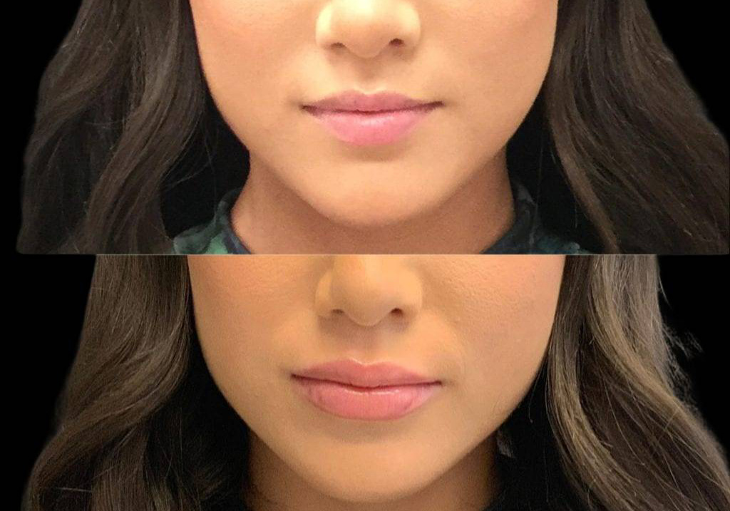 22-year-old-female-lip-augmentation-before-and-after.jpg