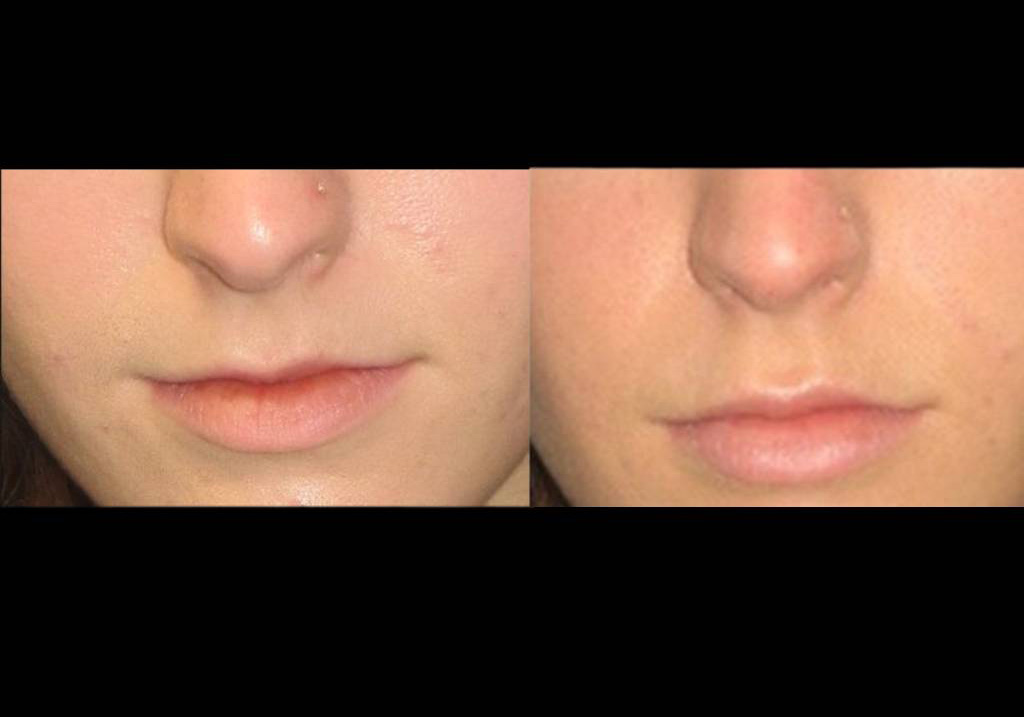 22-year-old-female-restylane-before-and-after-front-view-14464.jpg
