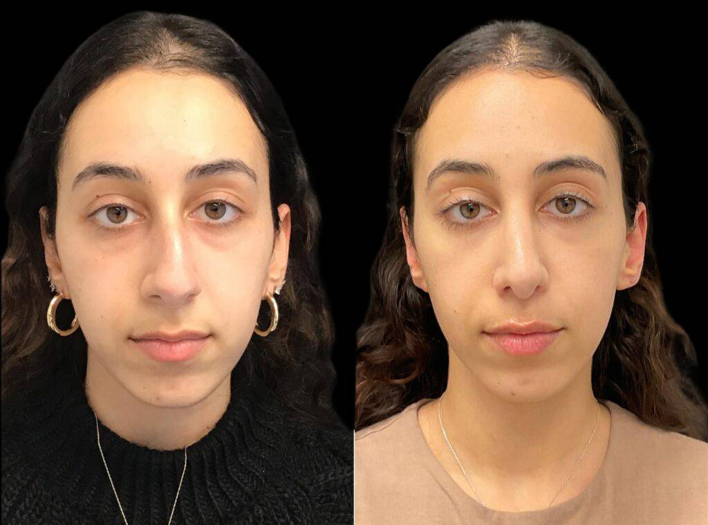 22-year-old-female-rhinoplasty-before-and-after-front-view-1.jpg