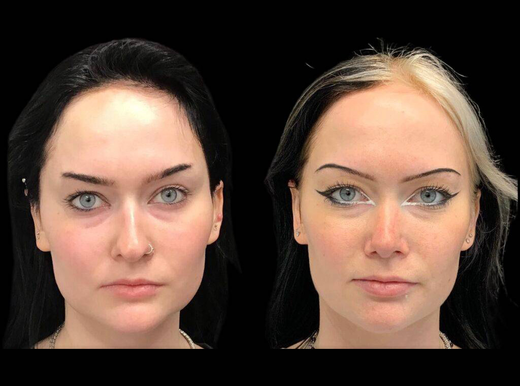 22-year-old-female-rhinoplasty-before-and-after-front-view-3.jpg