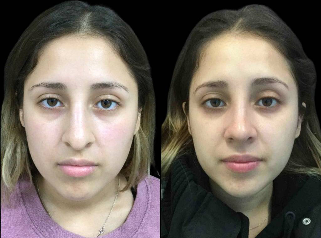 22-year-old-female-rhinoplasty-before-and-after-front-view.jpg