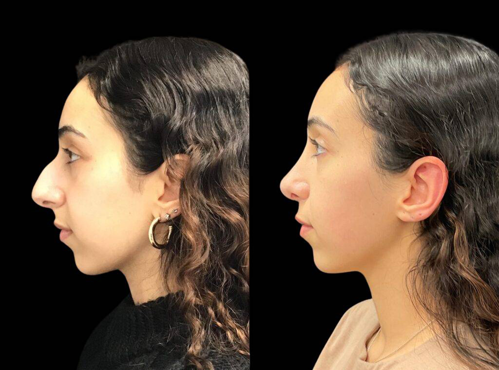 22-year-old-female-rhinoplasty-before-and-after-side-view-1.jpg