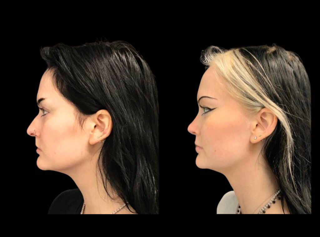 22-year-old-female-rhinoplasty-before-and-after-side-view-2-2.jpg