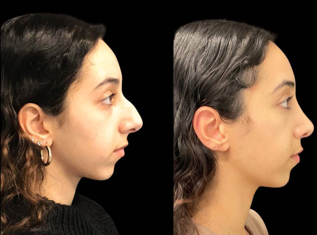 22-year-old-female-rhinoplasty-before-and-after-side-view-2.jpg
