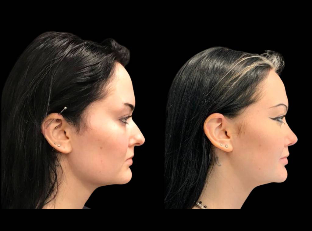 22-year-old-female-rhinoplasty-before-and-after-side-view-4.jpg