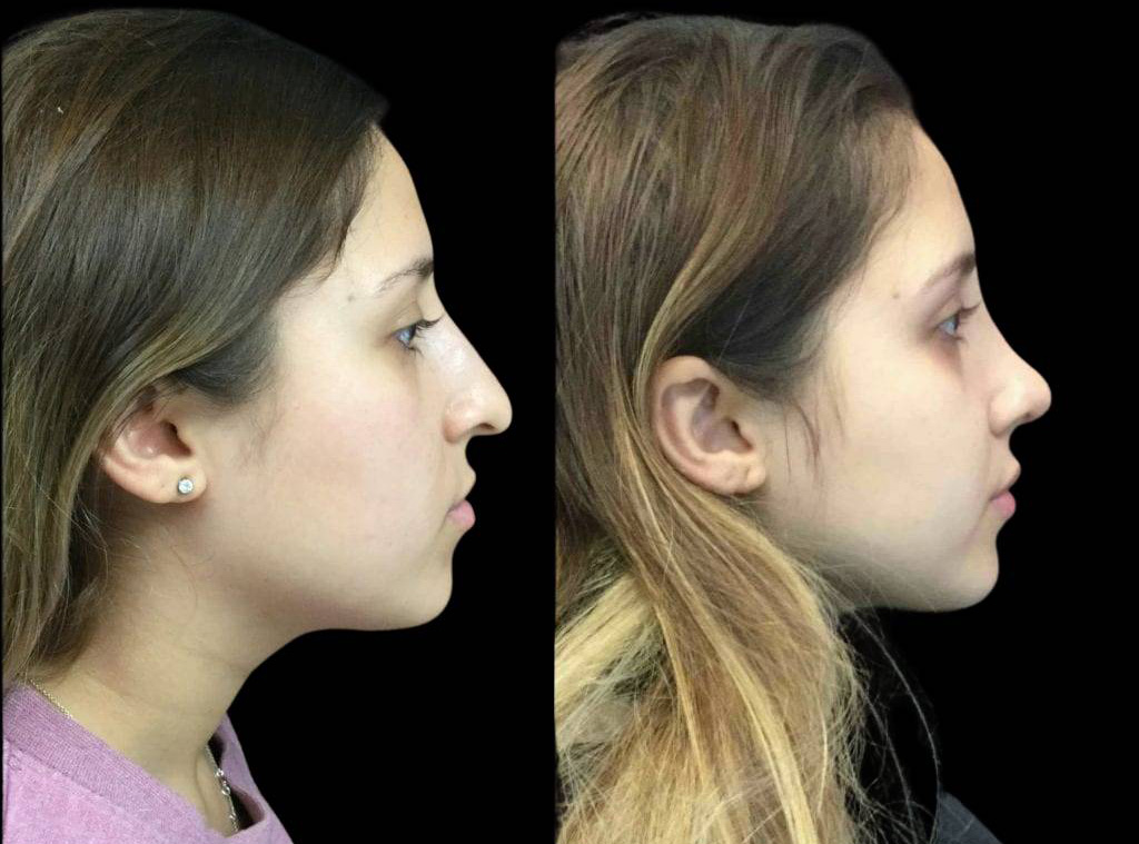 22-year-old-female-rhinoplasty-before-and-after-side-view.jpg