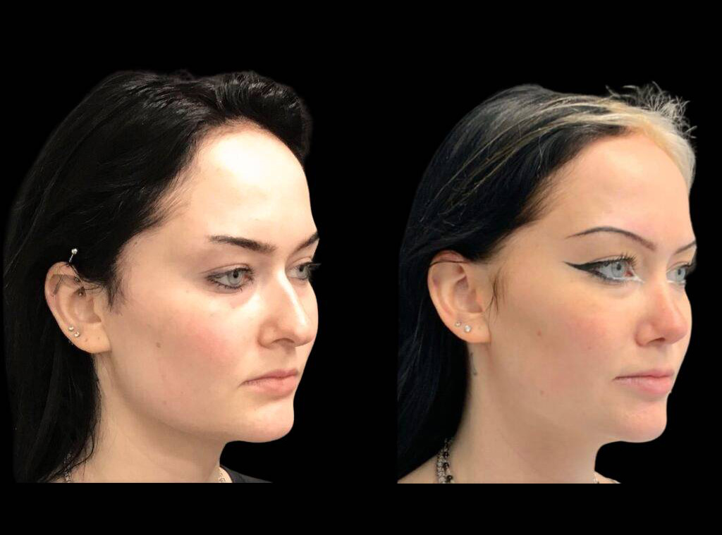 22-year-old-female-rhinoplasty-before-and-after-three-quarters-view-2-2.jpg