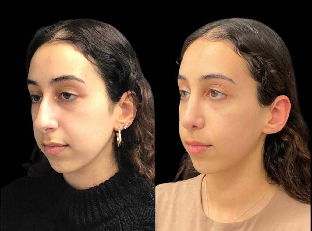 22-year-old-female-rhinoplasty-before-and-after-three-quarters-view-2.jpg