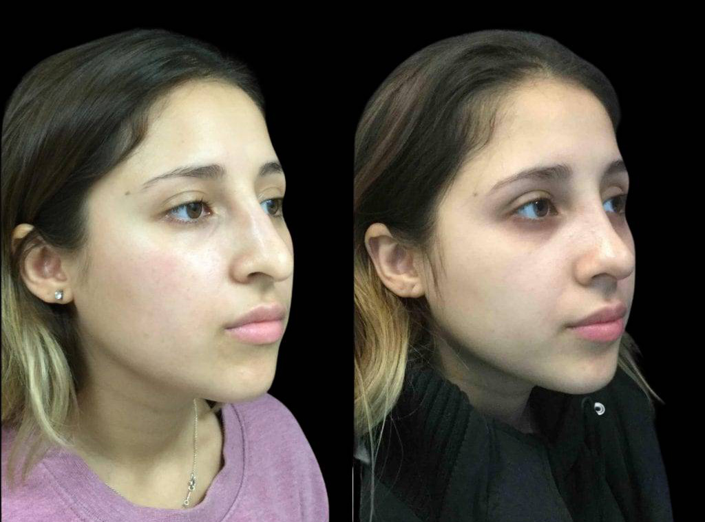 22-year-old-female-rhinoplasty-before-and-after-three-quarters-view.jpg