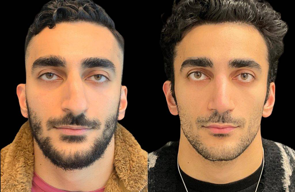22-year-old-male-rhinoplasty-before-and-after-front-view.jpg