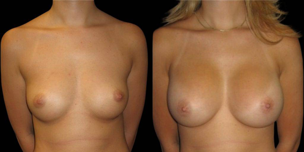 This is a 23-year-old female that has had a breast augmentation and implant showing the before and after's side-by-side