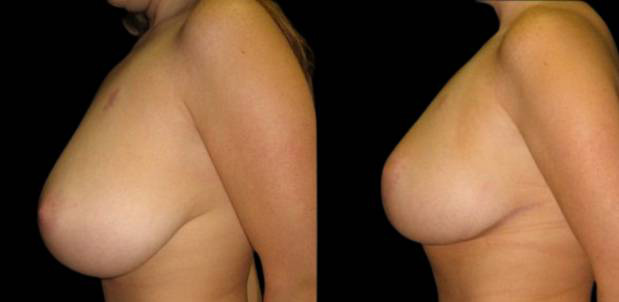 23-year-old-female-breast-reduction-before-and-after-side-view.jpg