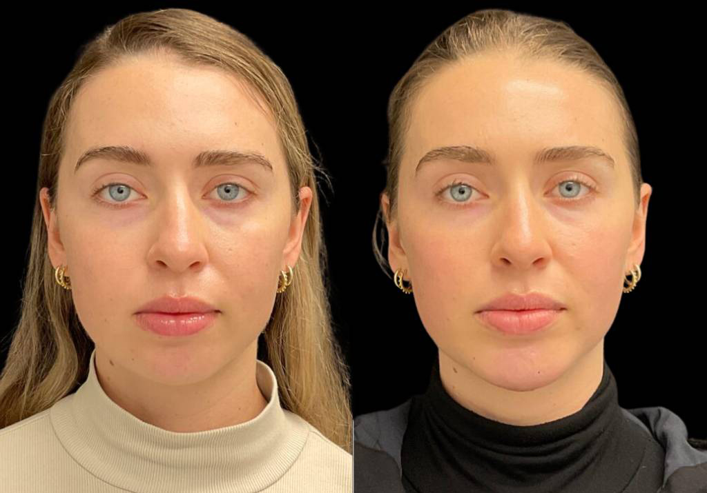 23-year-old-female-chin-implant-before-and-after-front-view-34260.jpg