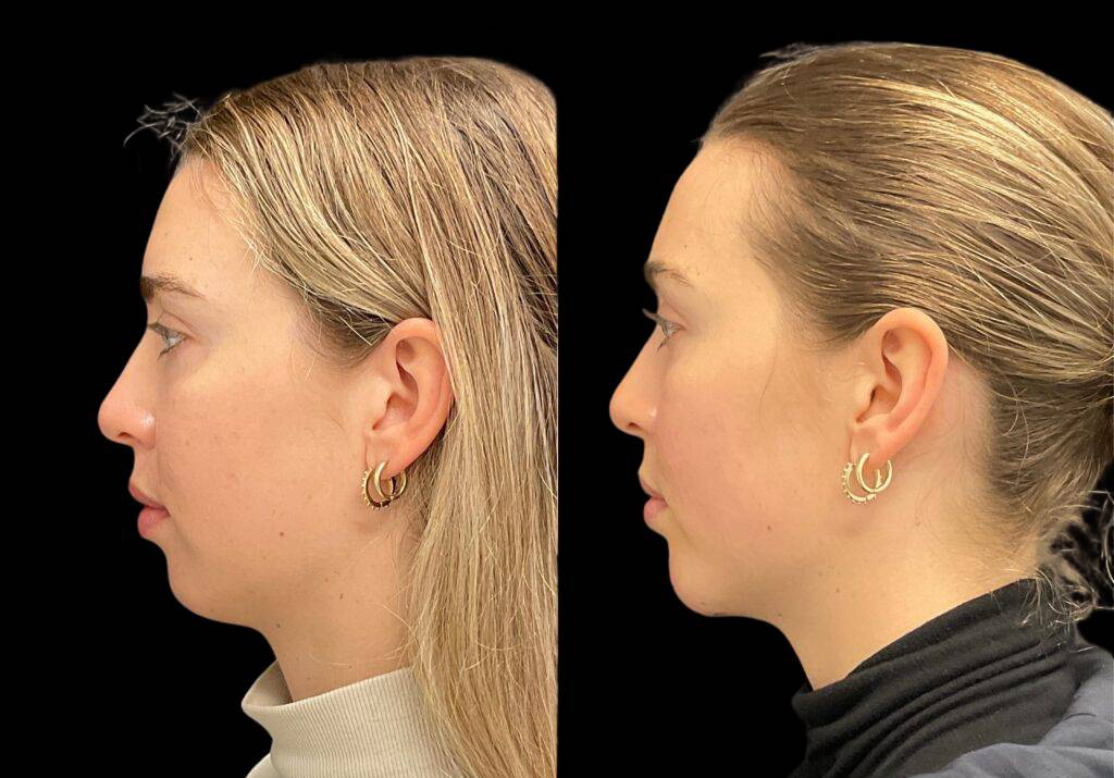 23-year-old-female-chin-implant-before-and-after-side-view-2.jpg