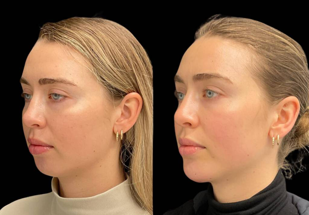 23-year-old-female-chin-implant-before-and-after-three-quarter-view-2.jpg