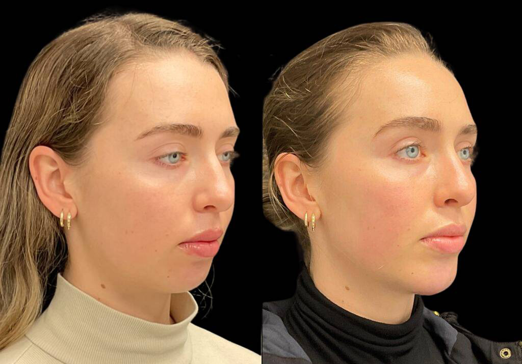 23-year-old-female-chin-implant-before-and-after-three-quarter-view.jpg