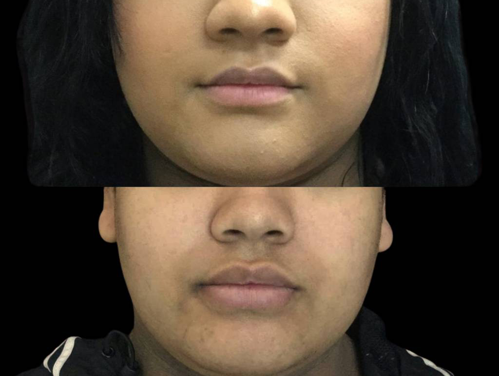 23-year-old-female-juvederm-before-and-after-front-view-27160.jpg