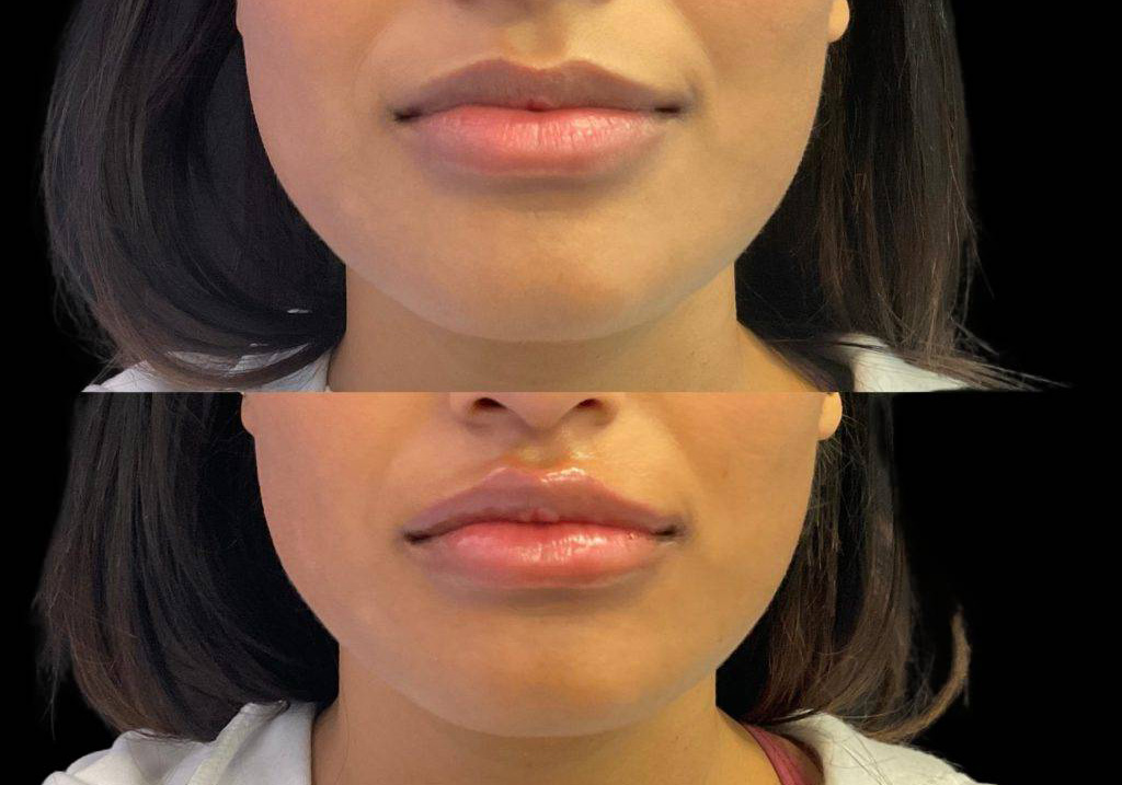 23-year-old-female-lip-augmentation-before-and-after-front-view.jpg
