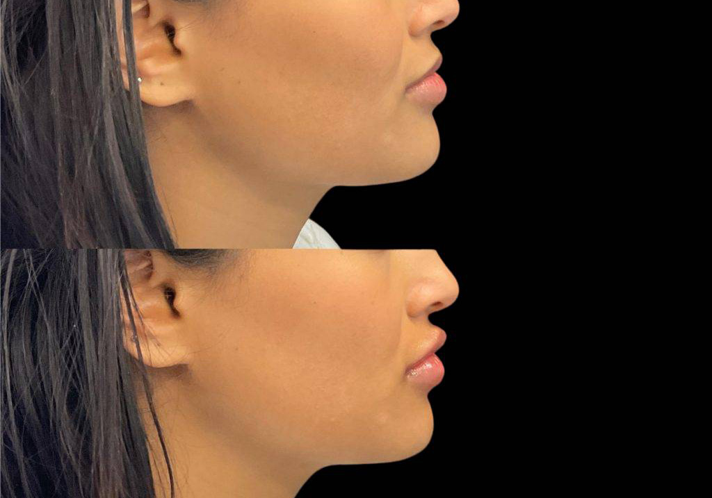 23-year-old-female-lip-augmentation-before-and-after-side-view.jpg