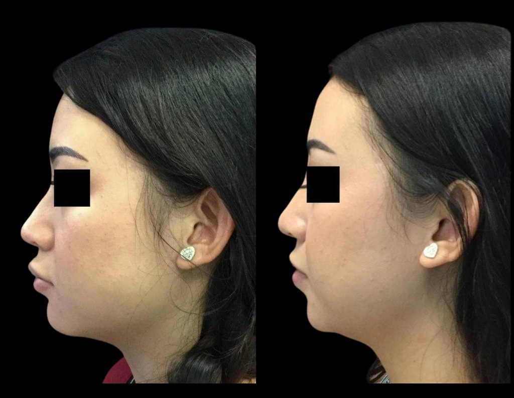 23-year-old-female-non-surgical-rhinoplasty-side-view.jpg