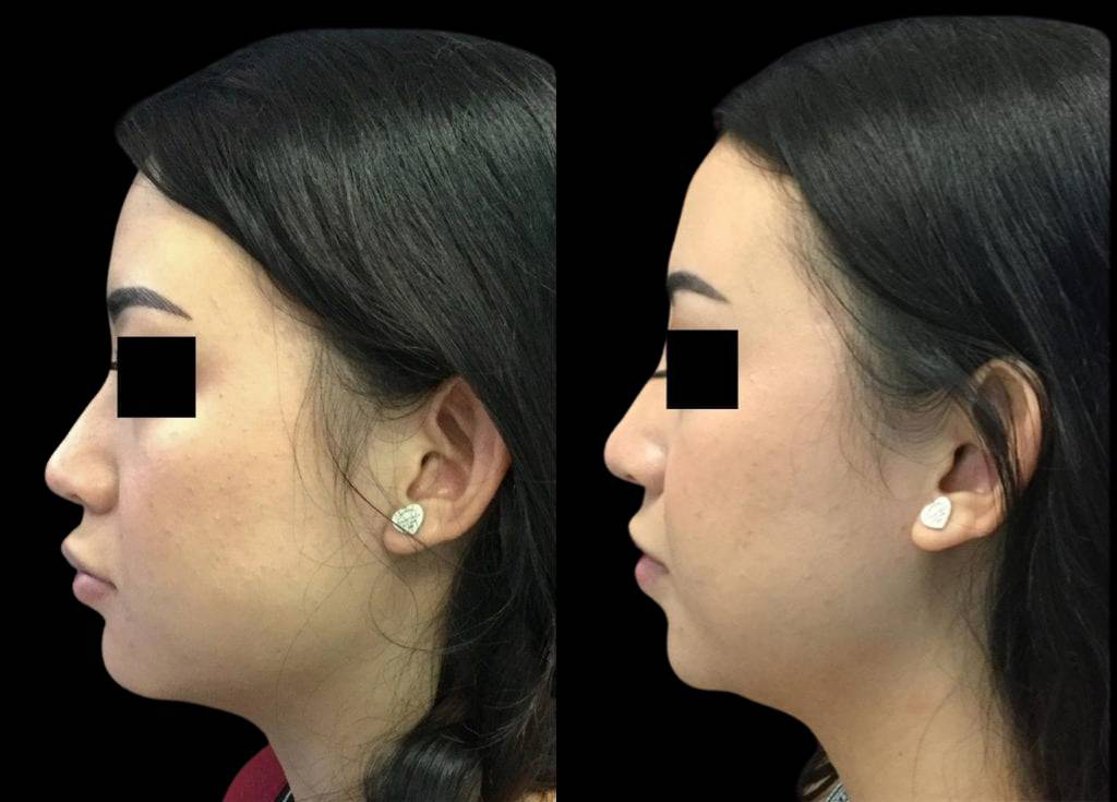 23-year-old-female-non-surgical-rhinoplasty-side-view.jpg