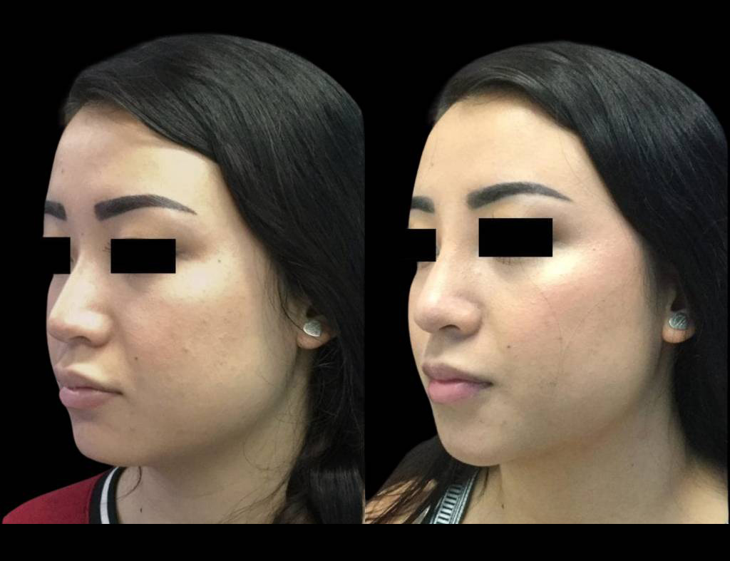 23-year-old-female-non-surgical-rhinoplasty-three-quarters-view.jpg