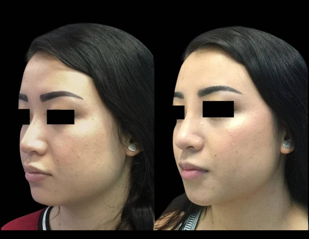 23-year-old-female-non-surgical-rhinoplasty-three-quarters-view.jpg