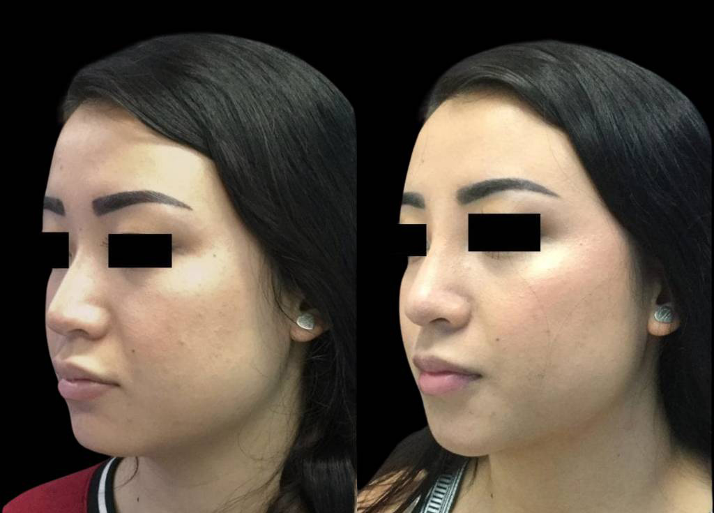 23-year-old-female-non-surgical-rhinoplasty-three-quarters-view.jpg