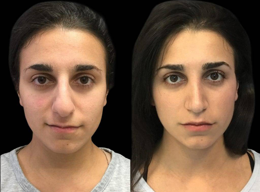 23-year-old-female-rhinoplasty-before-and-after-front-view-1.jpg