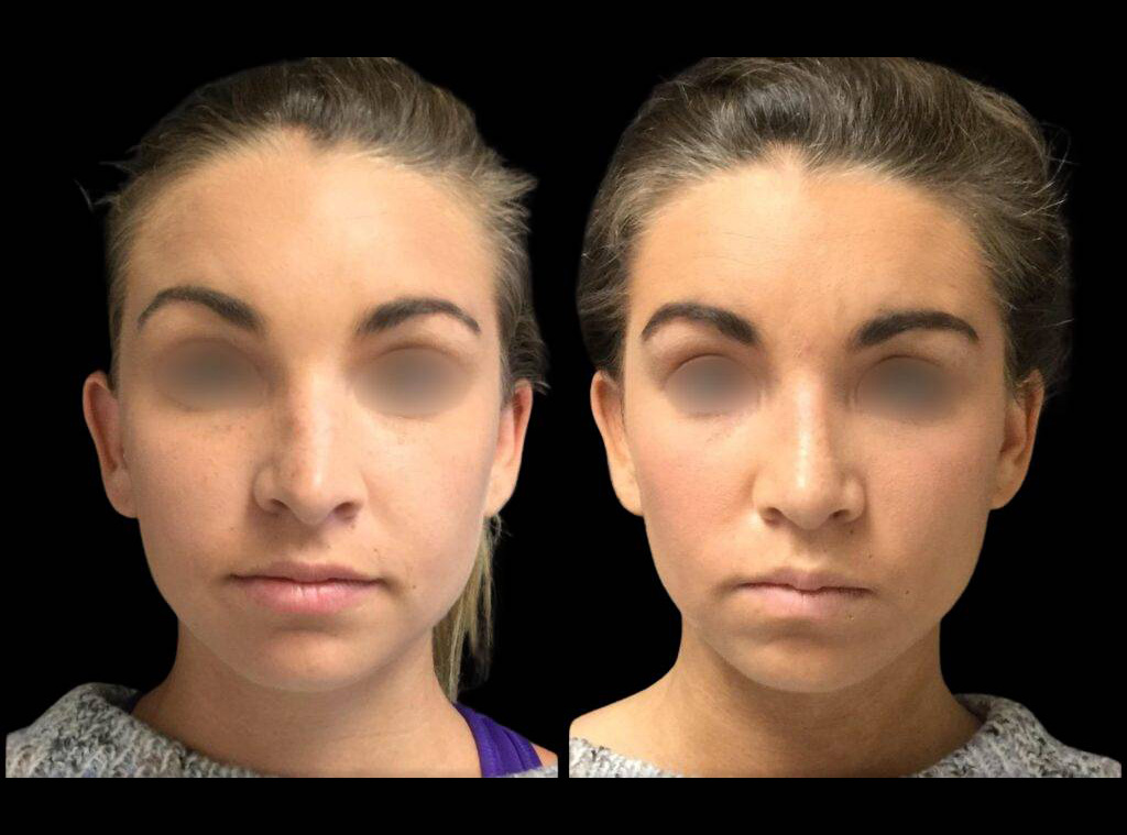 23-year-old-female-rhinoplasty-before-and-after-front-view.jpg