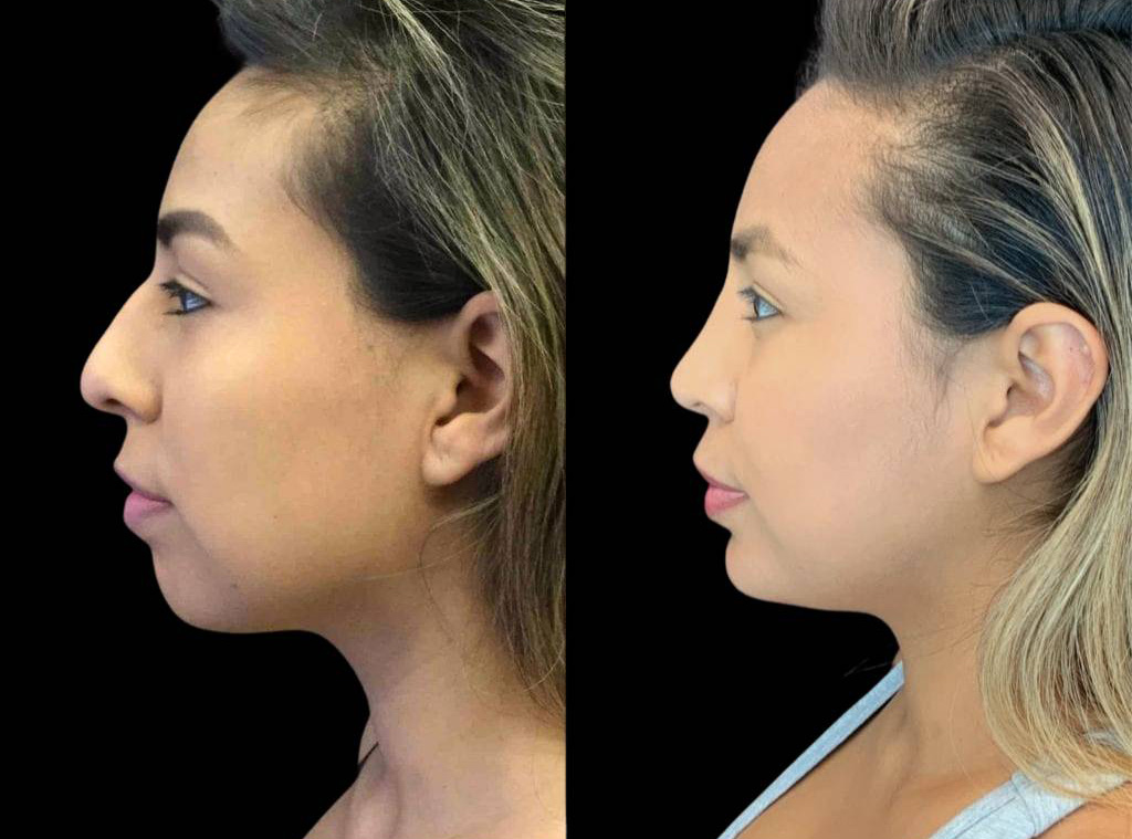 23-year-old-female-rhinoplasty-before-and-after-side-view-.jpg