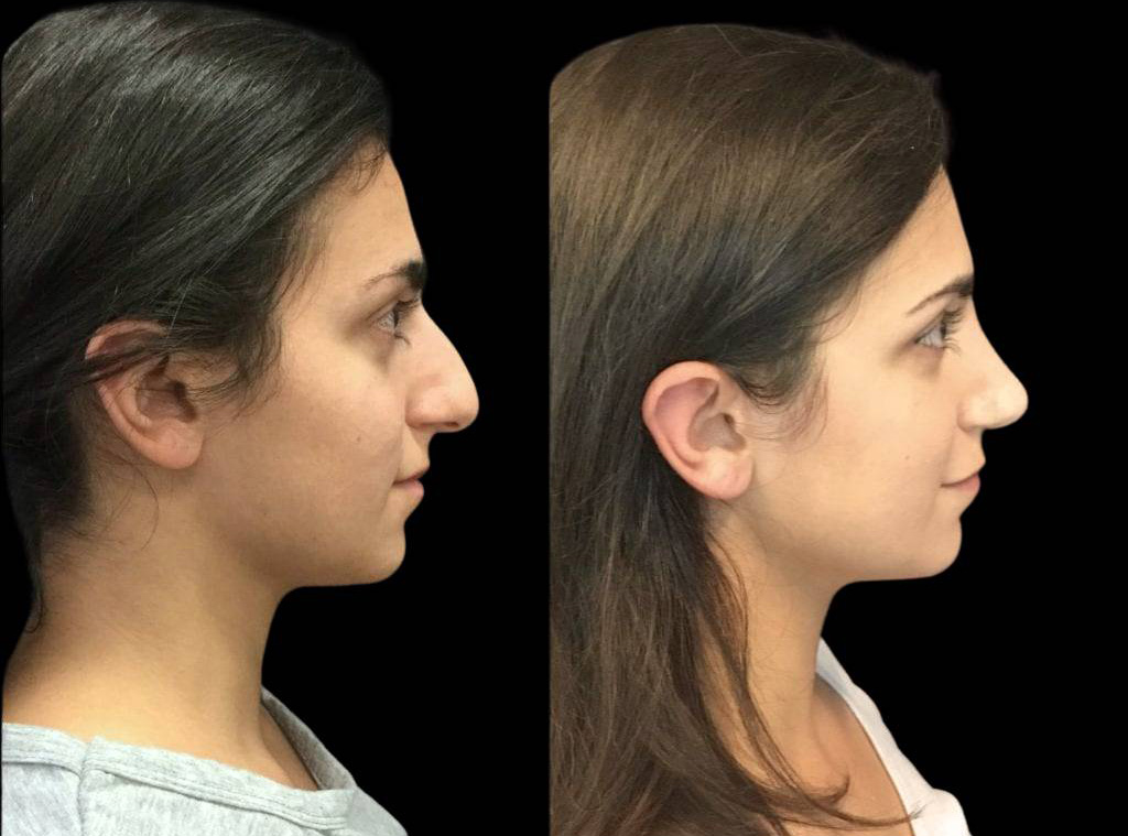 23-year-old-female-rhinoplasty-before-and-after-side-view-1.jpg