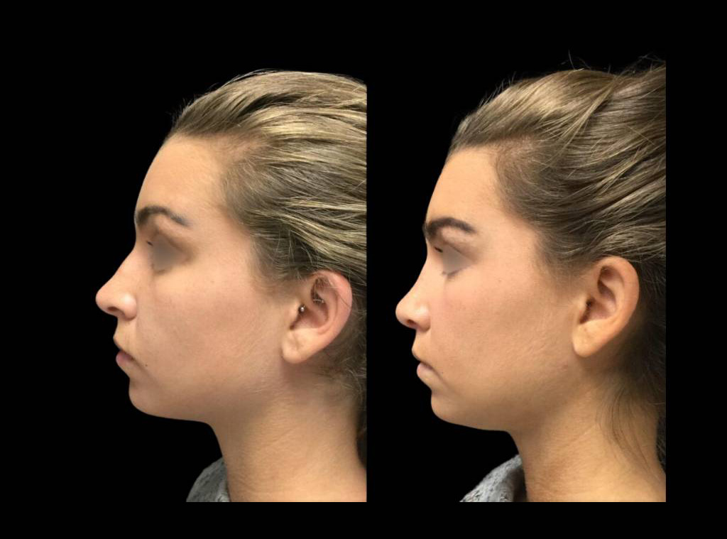23-year-old-female-rhinoplasty-before-and-after-side-view.jpg