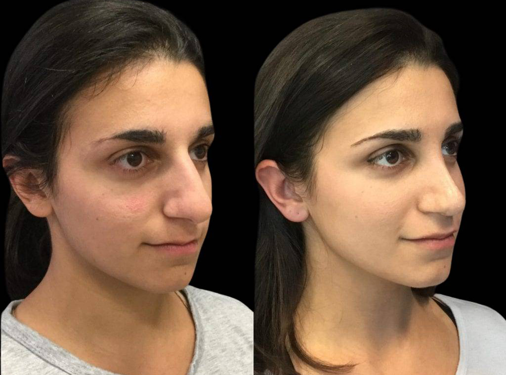 23-year-old-female-rhinoplasty-before-and-after-three-quarters-view.jpg