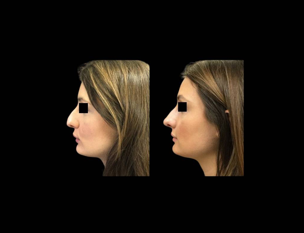 23-year-old-female-rhinoplasty-side-view.jpg