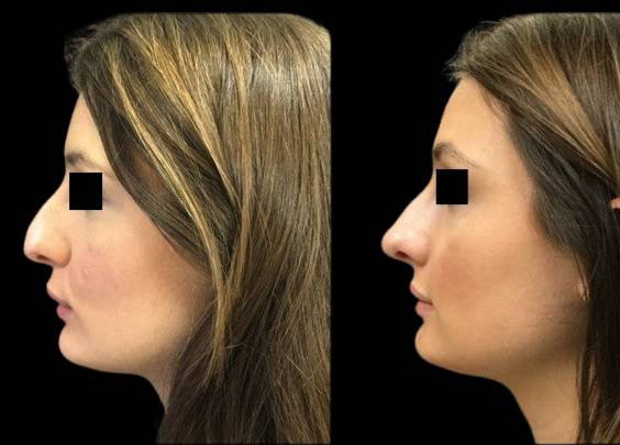 23-year-old-female-rhinoplasty-side-view.jpg