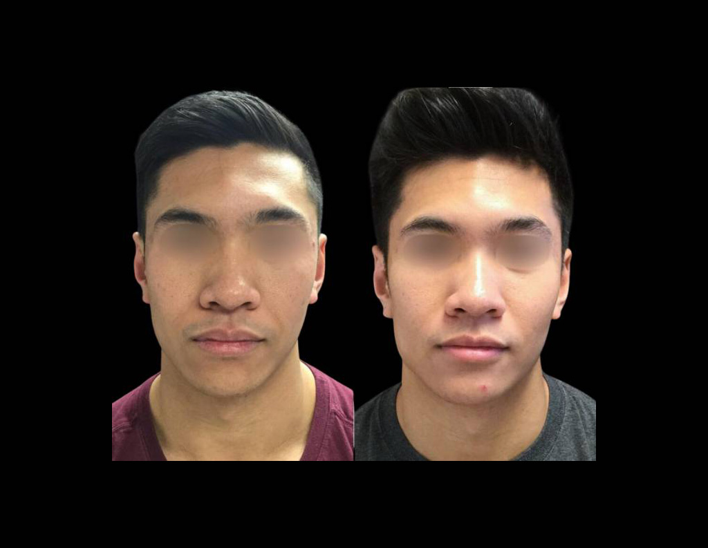 23-year-old-male-non-surgical-cheek-augmentation-before-and-after-front-view-22858.jpg