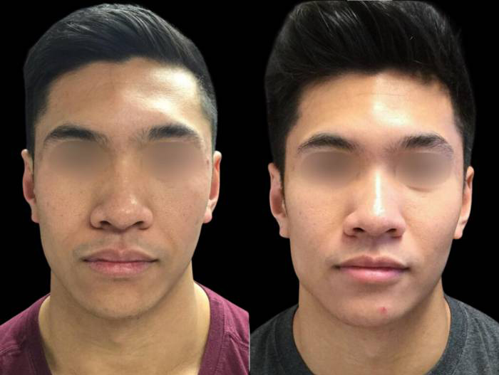 23-year-old-male-non-surgical-cheek-augmentation-before-and-after-front-view-22858.jpg