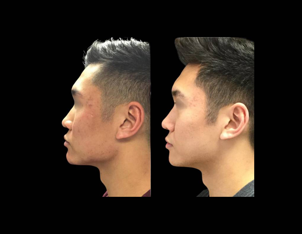 23-year-old-male-non-surgical-cheek-augmentation-before-and-after-side-view.jpg