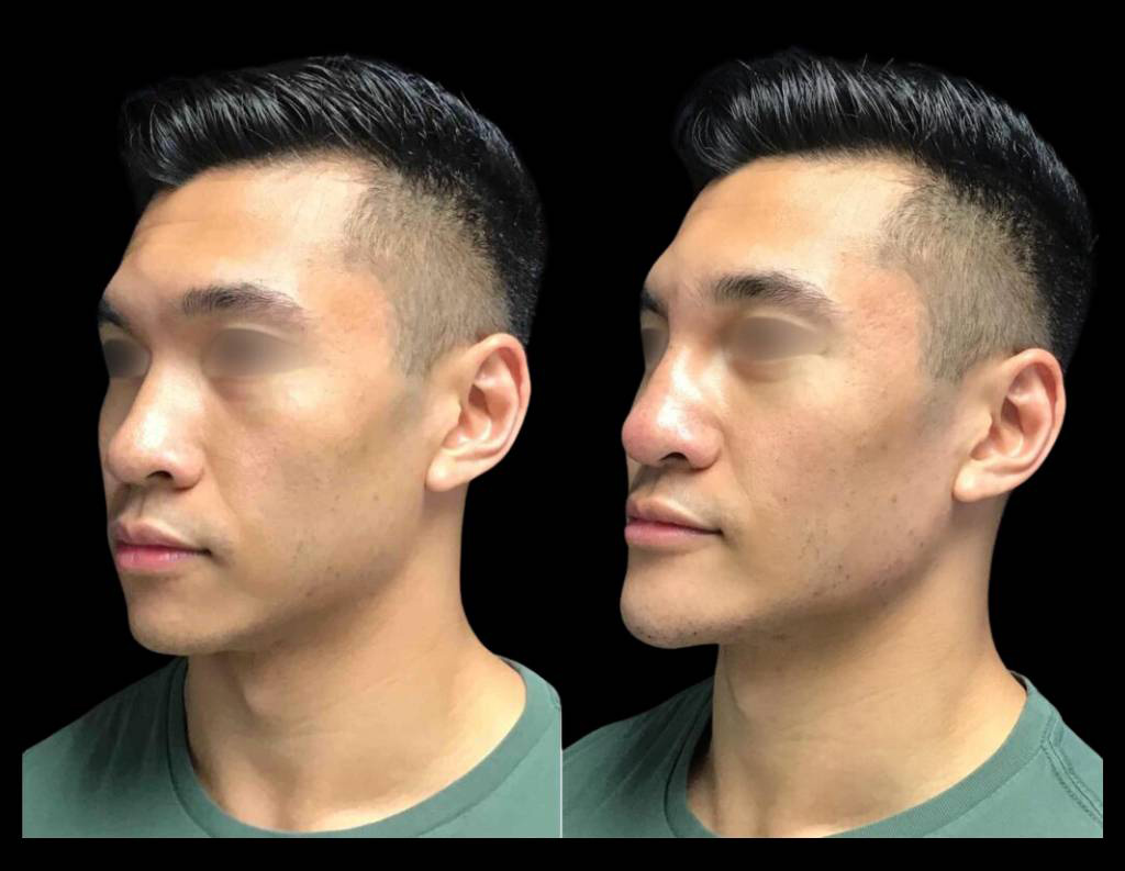 23-year-old-male-non-surgical-chin-augmentation-before-and-after-1.jpg