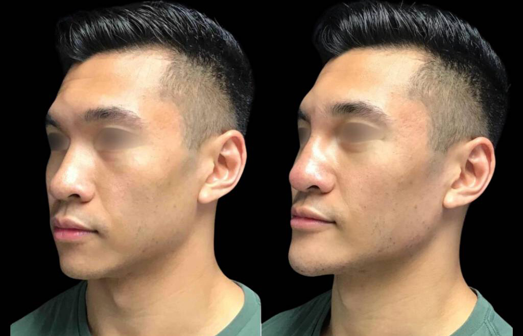 23-year-old-male-non-surgical-chin-augmentation-before-and-after-1.jpg