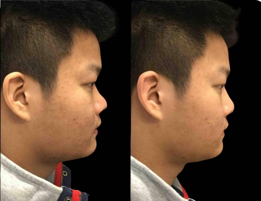 23-year-old-male-non-surgical-rhinoplasty-side-view.jpg