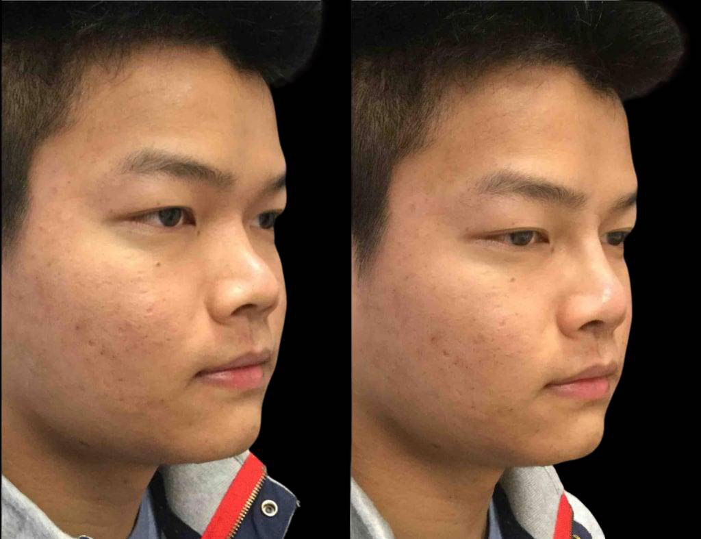 23-year-old-male-non-surgical-rhinoplasty-three-quarters-view.jpg