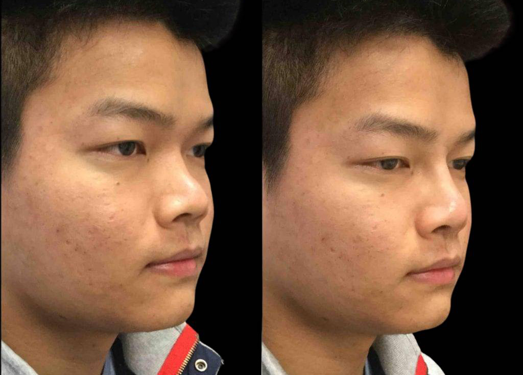23-year-old-male-non-surgical-rhinoplasty-three-quarters-view.jpg