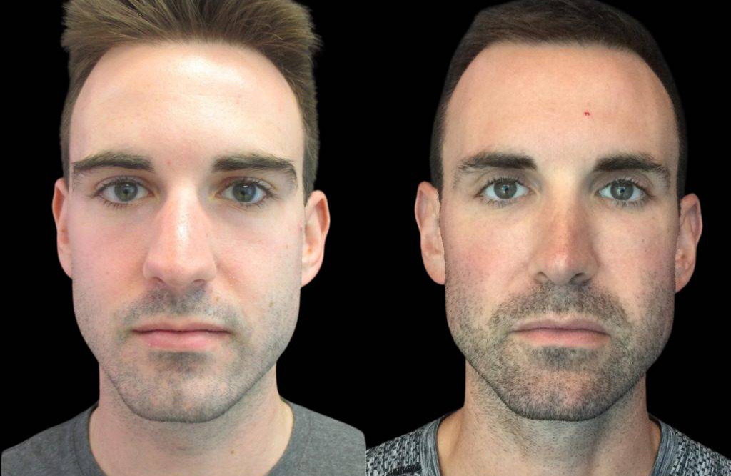 23-year-old-male-rhinoplasty-before-and-after-front-view.jpg