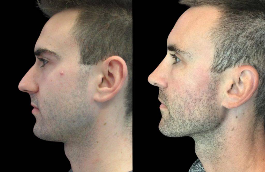 23-year-old-male-rhinoplasty-before-and-after-side-view.jpg