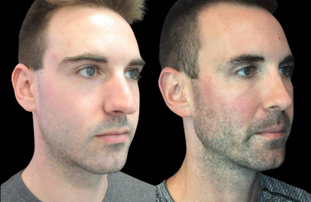 23-year-old-male-rhinoplasty-before-and-after-three-quarters-view.jpg