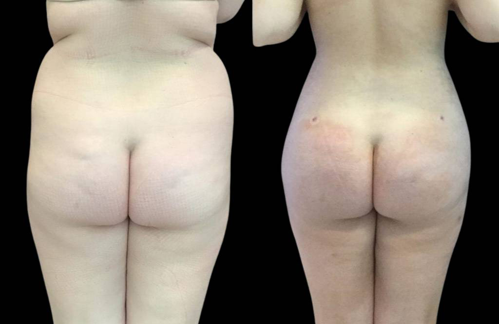 This is a 24-year-old female that has had a brazilian butt lift showing the before and after's side-by-side