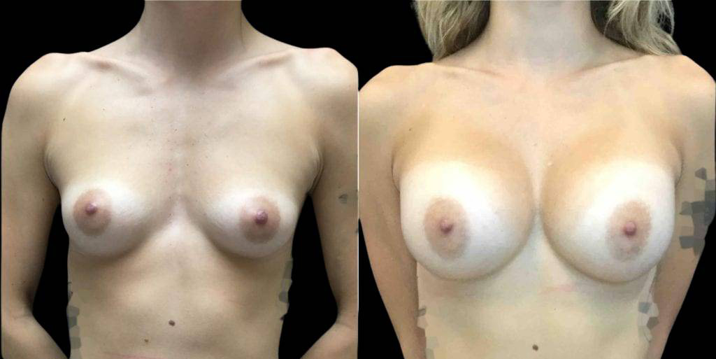 24-year-old-female-breast-augmentation-and-implant-before-and-after-front-view-350cc-23766.jpg